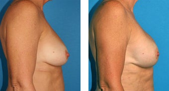 Breast Reconstruction: One-Stage Breast Reconstruction after 561803