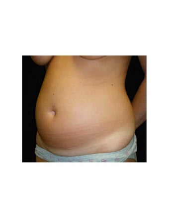 Mini Tummy Tuck on Female Patient 925735