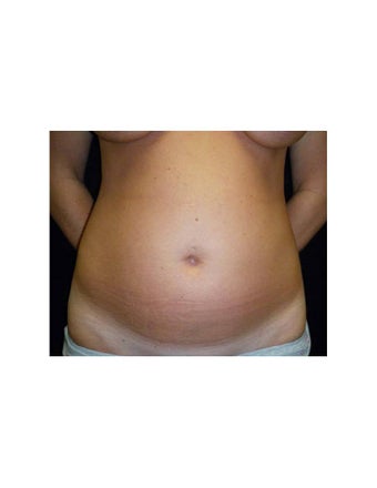 Mini Tummy Tuck on Female Patient before 925735