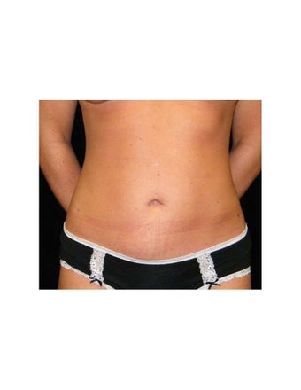 Mini Tummy Tuck on Female Patient after 925735