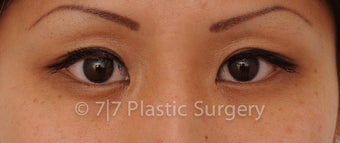 25 y.o. Asian female for Asian upper blepharoplasty after 1218104