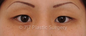 25 y.o. Asian female for Asian upper blepharoplasty before 1218104