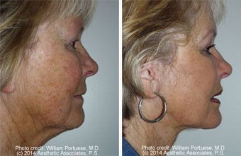 Facelift with dermabrasion before 91402