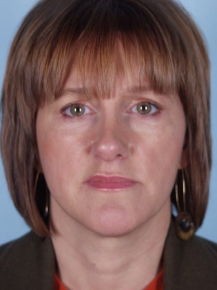 Lower Eyelid Hetter Peel before 857116