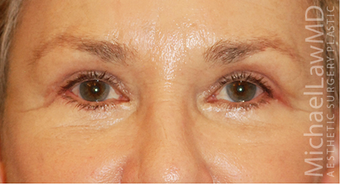 Eye Bag Surgery after 886859