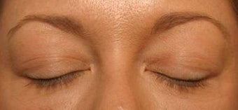 LATISSE before 270411