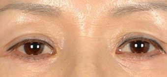Asian Eyelid Surgery after 1208025