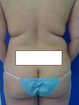 Laser Lipo before 333245