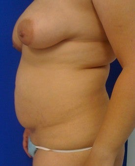 Laser Lipo 333245