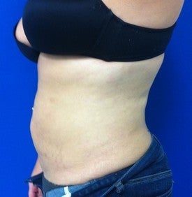 Laser Lipo 333245