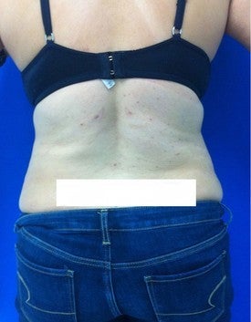 Laser Lipo after 333245