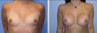 Breast Augmentation before 256387