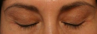 LATISSE before 270409