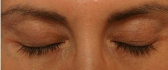 LATISSE after 270409