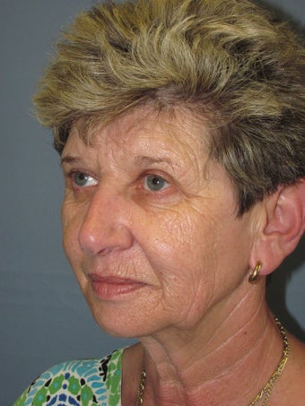 LiteLift™, Blepharoplasty, Brow Lift on 57-year-old Woman 413725