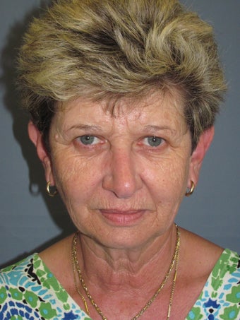 LiteLift™, Blepharoplasty, Brow Lift on 57-year-old Woman before 413725