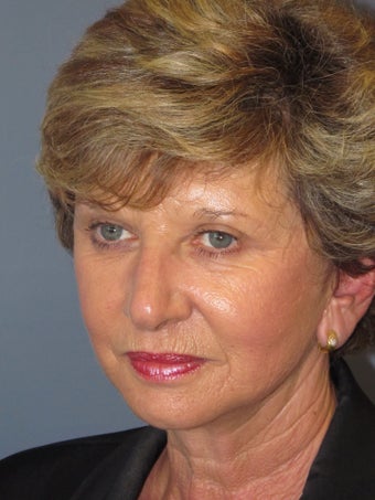 LiteLift™, Blepharoplasty, Brow Lift on 57-year-old Woman 413725