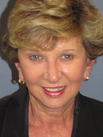 LiteLift™, Blepharoplasty, Brow Lift on 57-year-old Woman after 413725