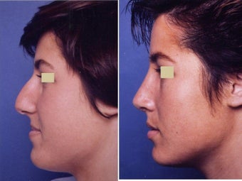 Rhinoplasty before 139105