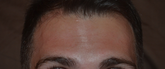 30 Year Old Male Treated For Forehead Lines after 1380335