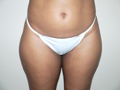 Liposuction before 677491