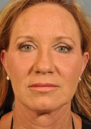 Lower lid Hetter Peel after 857692