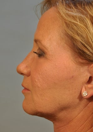 Lower lid Hetter Peel 857692