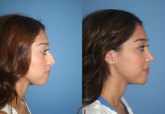 Ethnic Rhinoplasty after 418263