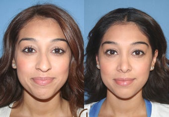 Ethnic Rhinoplasty before 418263