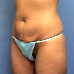 Mini Tummy Tuck before 464484