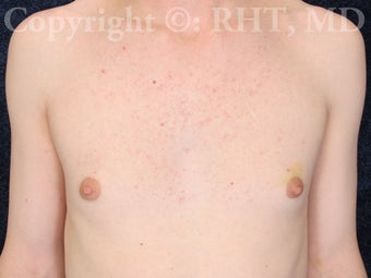 Transgender (M-F) breast augmentation before 307469