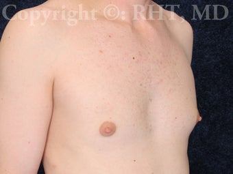 Transgender (M-F) breast augmentation 307469