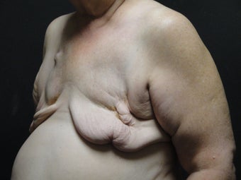 Breast reconstruction - tissue expanders 877967