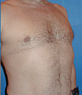 Pec Implants 887761