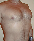 Pec Implants 887761