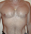 Pec Implants after 887761