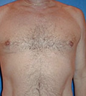 Pec Implants before 887761