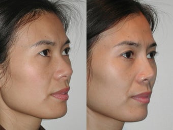 Asian Rhinoplasty before 922061