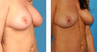 Breast Implant Removal with Internal Lift 562121