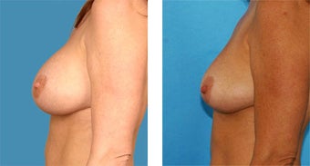 Breast Implant Removal with Internal Lift after 562121