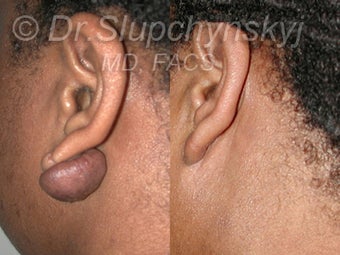 Earlobe Keloid before 1117231