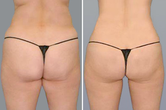 SmartLipo before 996915