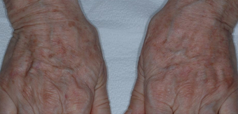 Hand Rejuvenation With Radiesse after 1367248