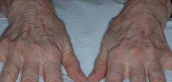 Hand Rejuvenation With Radiesse before 1367248