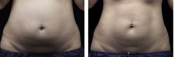 LIPOSONIX before 511487