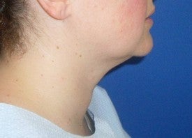 Laser Liposuction 561212
