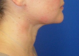 Laser Liposuction 561212