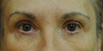 Fractionated CO2 Laser Treatment for Facial Wrinkles and Aging before 902540