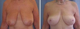 61 years old / breast reduction before 343929