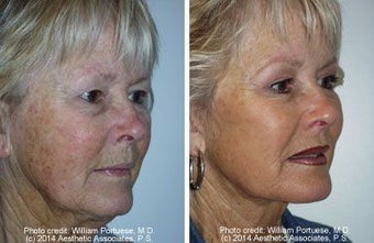 Facelift with dermabrasion before 91403